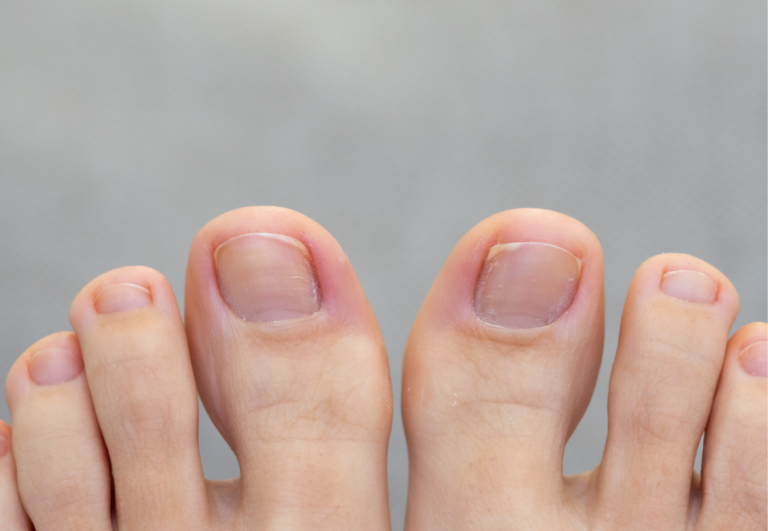 How Toe Spacers Can Correct Bunions: Exploring the Potential Benefits