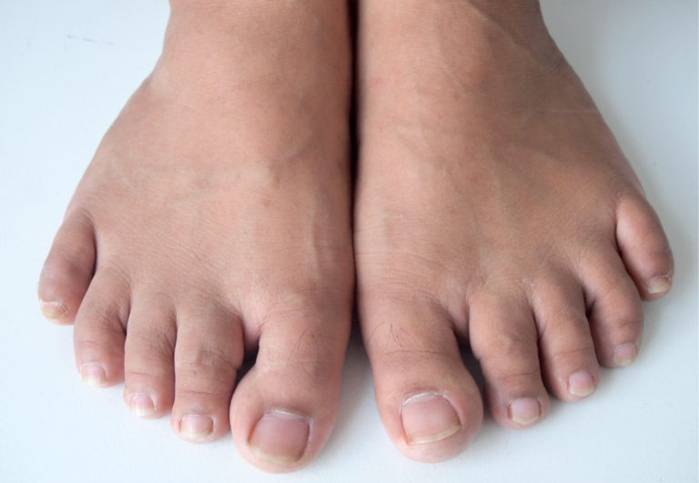 How Toe Spacers Can Help with Neuropathy: Examining the Potential Benefits