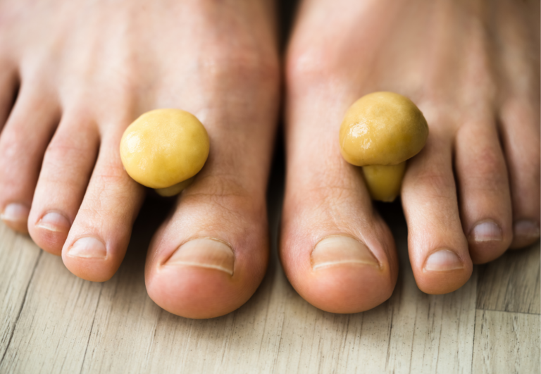 How Toe Spacers Can Reduce the Risk of Fungal Infections: Potential Protective Benefits