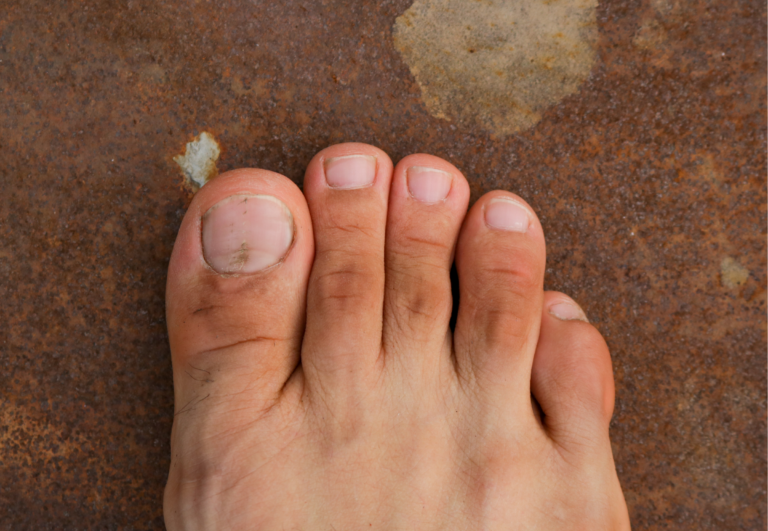 Natural Remedies for Hammer Toes: Effective Foot Care Strategies