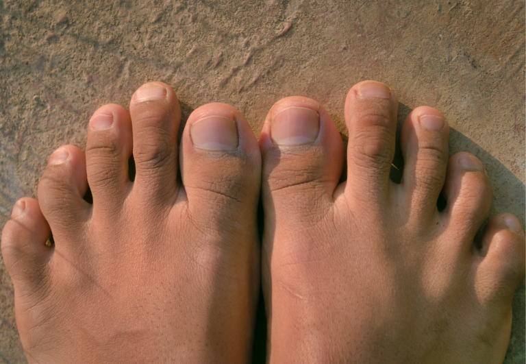 How Toe Spacers Can Relieve Foot Discomfort: Exploring the Potential Benefits